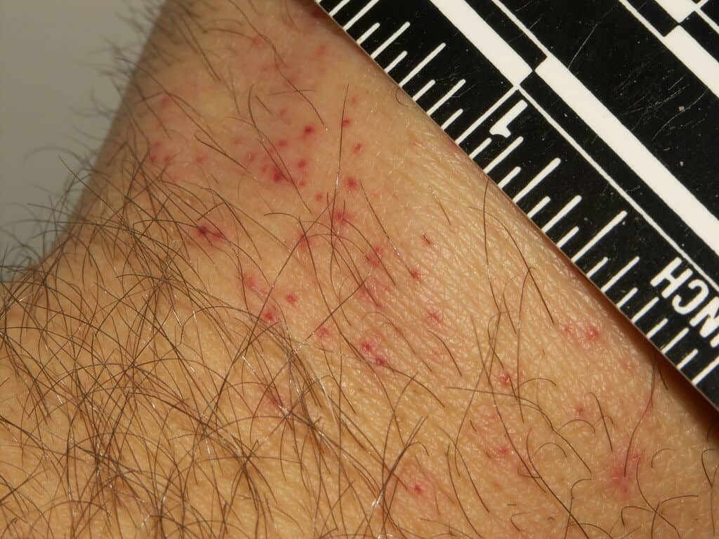 piqure punaise de lit